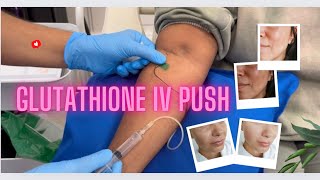 How to prepare amp administer Glutathione IV Push for full body skin whitening glutathione white [upl. by Noraf]