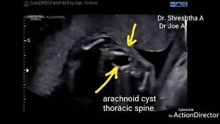 Spinal arachnoid cyst fetus ultrasound video [upl. by Sherlocke]