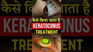 कैसे किया जाता है Keratoconus Treatment [upl. by Corette879]