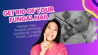 How to TREAT Fungal Nail  Get Rid Of Nail Fungus [upl. by Larrisa]