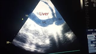 IVC ultrasound [upl. by Nahc]