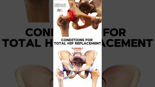 Conditions for Total Hip Replacement medical animation 3d short Biology with Aliya [upl. by Yssirhc652]