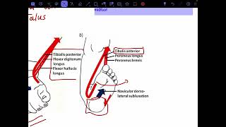 Talipes calcaneovalgus [upl. by Zwick]