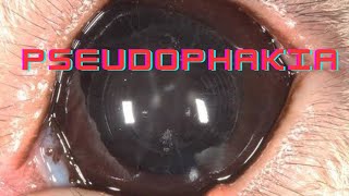 Pseudophakia  Artephakia  Ophthalmology Lecture [upl. by Wexler]