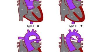 Truncus arteriosis [upl. by Hutner]