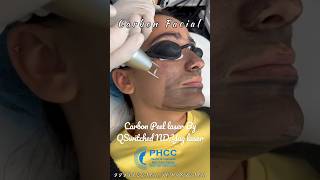 Carbon Laser Facial getsmarthairclub skintreatment shorts shortvideo shortsfeed [upl. by Adis]