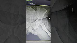 Fracture of ilium bone hip jointparamedicalclasses anatomy [upl. by Nostaw]