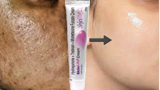 SkinLite Cream  remove pigmentation dark spots Acne marks pimple marks [upl. by Atsuj174]