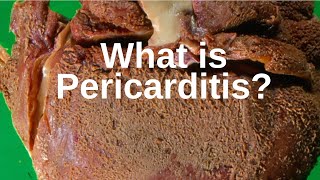 What is Pericarditis  Pathology mini tutorial [upl. by Mcdougall]