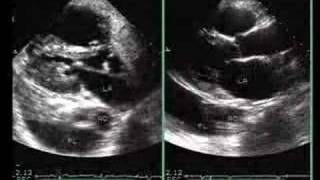 Pericardial Effusion versus Pleural Effusion [upl. by Notse]