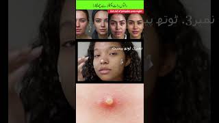 How to remove pimples overnight  pimples removal on face at home fast pimple removal home remedies [upl. by Aleek]