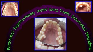 Paramolar  Supernumerary Teeth  Extra Teeth  Distomolar Mesiodens [upl. by Ube]