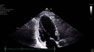 Mid Wall Stress Cardiomyopathy [upl. by Vernier]