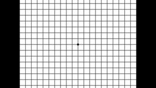 Macular Degeneration Vision Test Using Amsler Grid [upl. by Tymes]