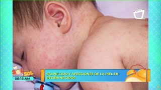 ¿Qué es y cómo se contagia el Herpes Zóster [upl. by Sharlene620]