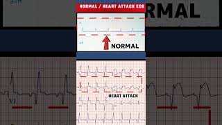 हार्ट अटैक का ECG  HEART ATTACK ECG VS NORMAL ECGshorts [upl. by Stoughton776]