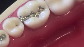 class II amalgam cavity preparation and restoration [upl. by Werna319]