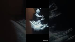 Echocardiography echocardiography echocardiographer echo video echo case [upl. by Fiona643]