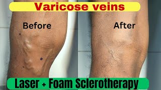 Varicose veins treatment  3 month follow up result Laser treatment  Foam Sclerotherapy treatment [upl. by Sarita]