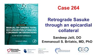 Case 264 Manual of CTO PCI Retrograde Sasuke through an epicardial collateral [upl. by Enobe522]