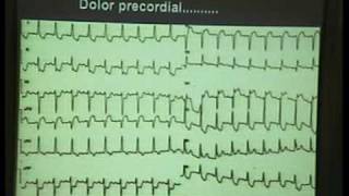 Curso ECG 2010  01 Fibrilación Ventricular [upl. by Barbi241]