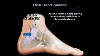 Tarsal Tunnel Syndrome causes and treatment [upl. by Curtis176]