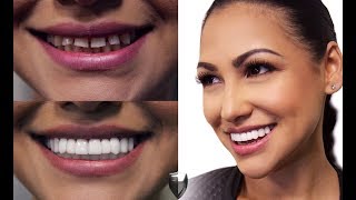 Fixing Gapped Teeth Without A Dentist See Why Cosmetic Dental Veneers Are Better Than Braces [upl. by Relyuc]