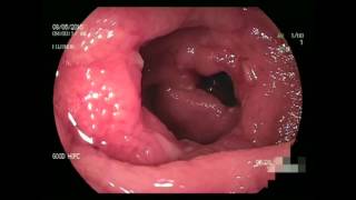 Double Balloon Enteroscopy in Crohns disease [upl. by Nylhtac]