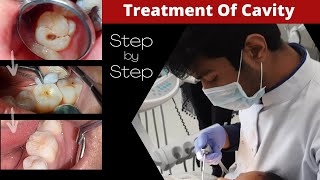 Composite Filling Step by Step  Cavity In Tooth  How To Fill Decayed Tooth  Dr Sunil Kumar [upl. by Ahseiyt826]