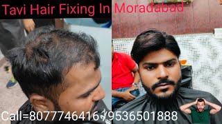 tavihairfixinginmoradabad3738 Non Surgical Clipping Hair Patch System [upl. by Hisbe]