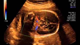 ECOGRAFIA 3D EMBARAZO 25 SEMANAS  ULTRASOUND 3D 25 WEEKS [upl. by Shaughnessy813]