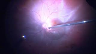 Surgery Vitrectomy for Retinal Detachment Assortment of Cases [upl. by Erl13]