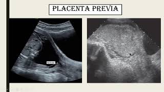 Ultrasonido Obstétrico del segundo semestre [upl. by Malissa842]