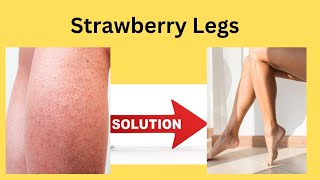 Strawberry Legs Solution  Malayalam [upl. by Goldia]