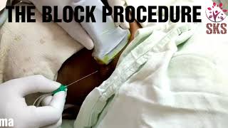 ULTRASOUND GUIDED BRACHIAL PLEXUS BLOCK INTERSCALENE APPROACHUSGUIDEDUPPER LIMB BLOCKSHOULDER [upl. by Idnis]