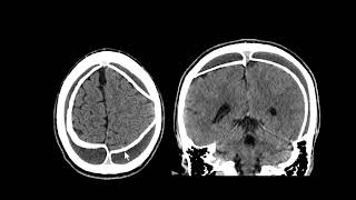 Hematoma subdural crônico calcificado [upl. by Madonia]