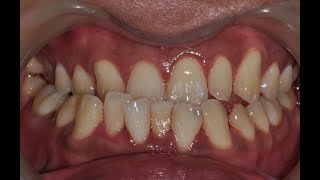 Class III Malocclusion  Underbite  La Submordida  Orthodontics Treatment  Braces [upl. by Aisatsan293]