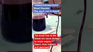 EXCESSIVE IRON in BLOOD VERY DANGEROUS Hemochromatosis shorts short family [upl. by Bruis]