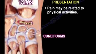 Kohlers Disease  Everything You Need To Know  Dr Nabil Ebraheim [upl. by Lekym587]