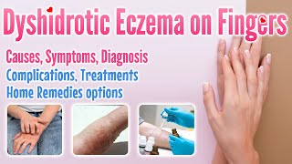 Dyshidrotic eczema on fingers overview causes symptoms treatment options and home remedies [upl. by Bogusz]