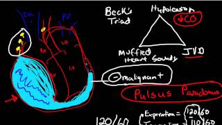 Oncologic Emergencies Cardiac Tamponade [upl. by Atiuqahc600]