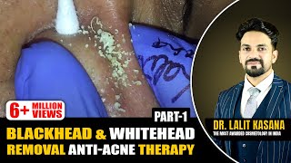 BLACKHEAD amp WHITEHEAD REMOVAL ANTIACNE THERAPY PART  1 [upl. by Balling]