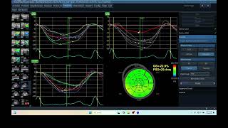 IQ 265 AFI LV ECHOPAC ANALYSIS ECHOCARDIOGRAPHY REPORT 2 [upl. by Gianina]