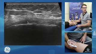 Sonographic assessment of the medial knee for POCUS clinicians [upl. by Nyrhtak]