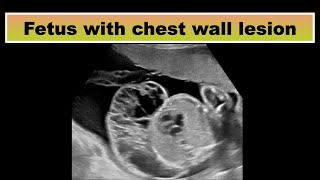 Fetus with chest wall lesion [upl. by Adnarym]