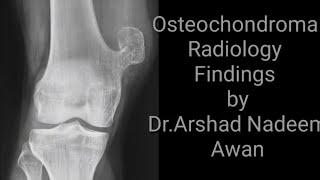 Osteochondroma Radiology x rays and CT images [upl. by Niuq]