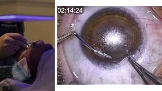 London Vision Clinic  ReLEx SMILE  Live laser eye surgery  Professor Dan Reinstein [upl. by Bolen893]