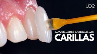 CARILLAS DENTALES  LO QUE DEBES SABER [upl. by Alius]