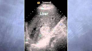 UCSF Radiology What Ultrasound Tells Us [upl. by Wayolle]