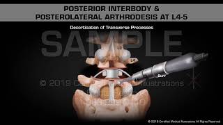 Posterior Interbody amp Posterolateral Arthrodesis at L45  Medical Animation [upl. by Tserrof212]